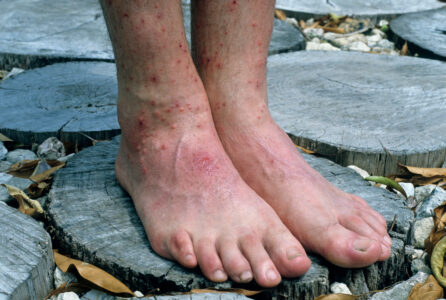 What to Do for Chigger Bites